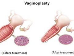 Vaginal Hysterectomy Surgery In Bharuch                        